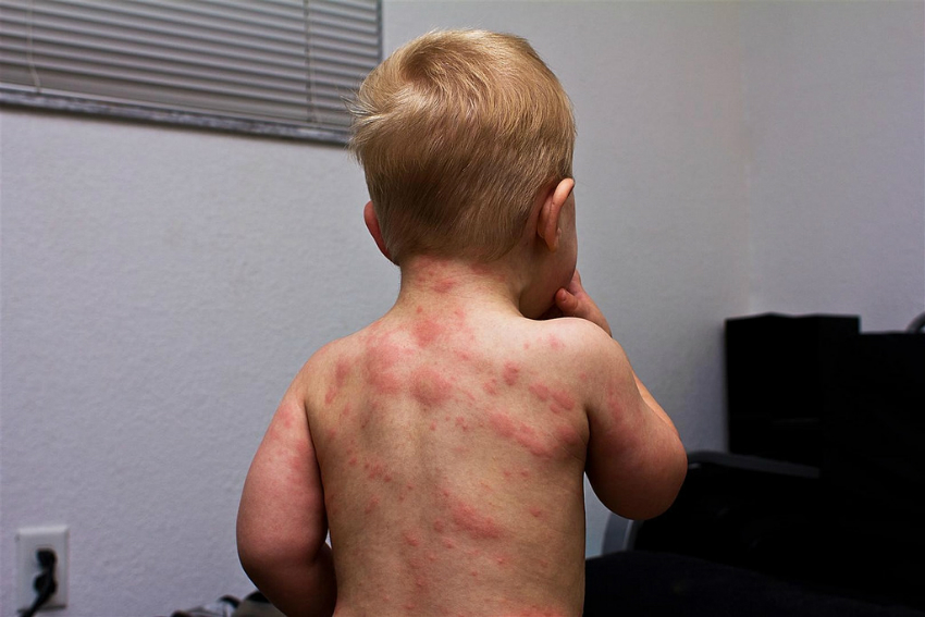 Pediatrik Roseola: Nedenleri ve Belirtileri Pediatrik Roseola: Nedenleri ve Belirtileri