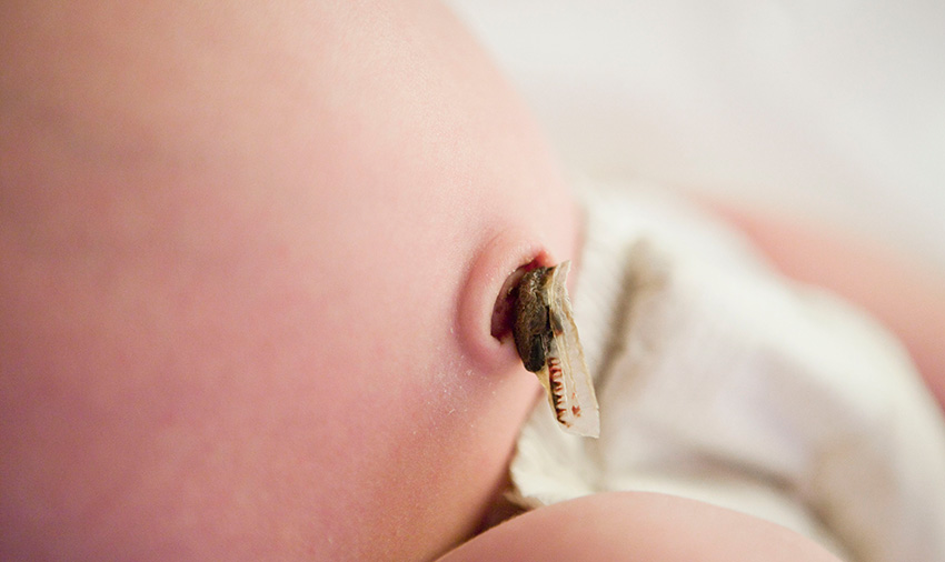 Bebeklerde Göbek Deliği İltihabı Belirtileri ve Tedavisi