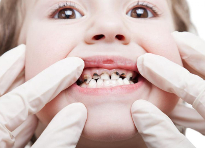 Biberon Çürüğü: Görüldüğünden Daha Tehlikeli!