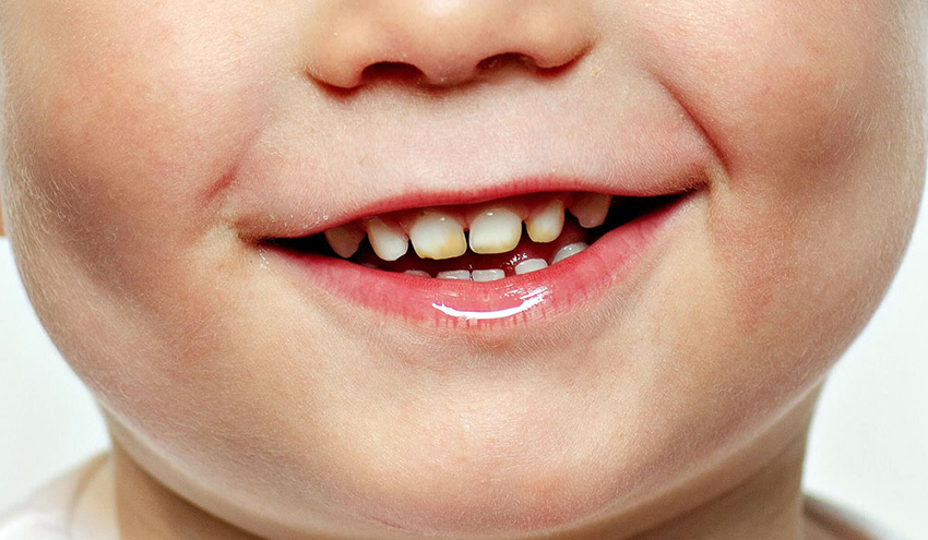 Çocuklarda Diş Çürümesinin Nedenleri ve Tedavisi