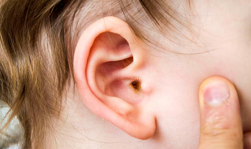 Çocuklarda Dış Kulak İltihabının Belirtileri ve Tedavisi