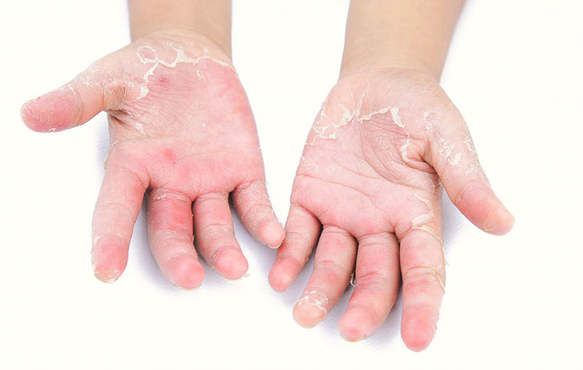 Çocuklarda Sedef Hastalığının Belirtileri ve Tedavisi