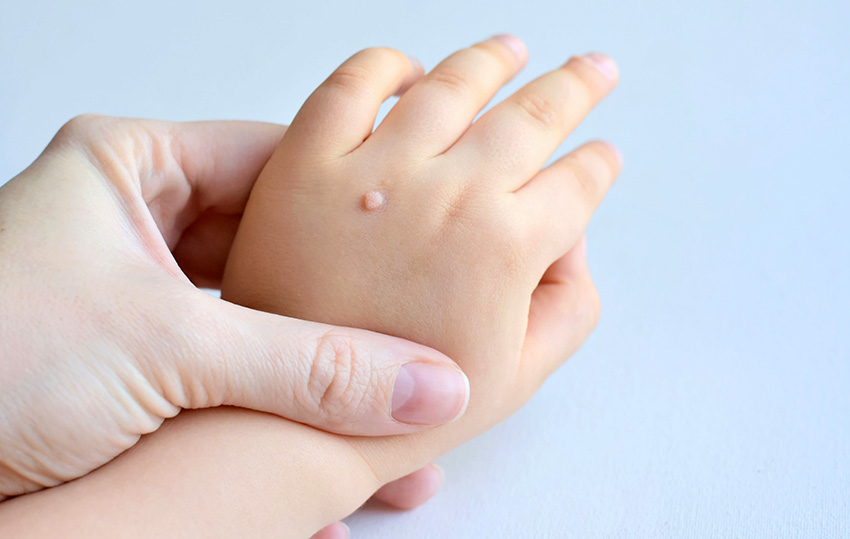 Çocuklarda Siğil Neden Olur, Nasıl Geçer?