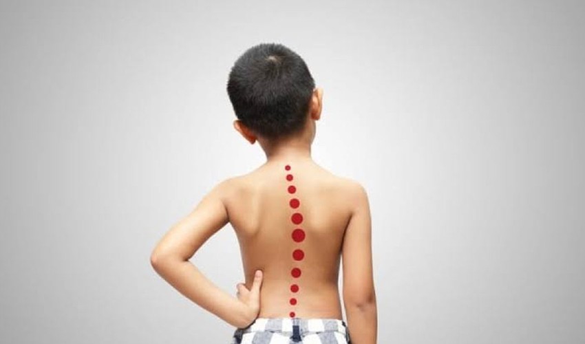 Çocuklarda Skolyoz Belirtileri ve Tedavisi