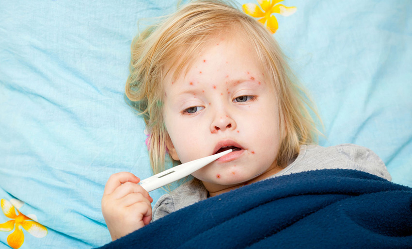 Çocuklarda Suçiçeği Belirtileri ve Tedavi Yöntemleri