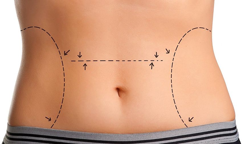 Doğum Sonrası Karın Germe Ameliyatı Hakkında Her Şey