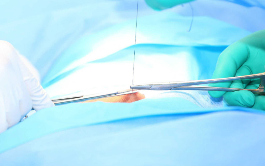 Epizyotomi Nedir? Doğum Dikişleri Kaç Günde İyileşir?