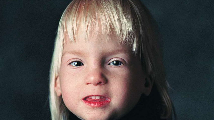 Fetal Alkol Sendromu Nedir? Neden Olur?