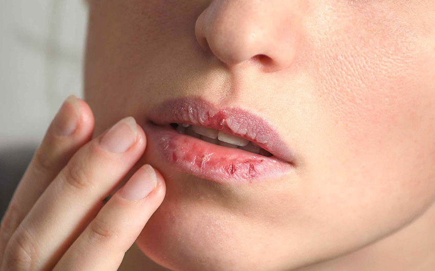 Hamilelikte Ağız Kuruluğu: Neden Olur, Nasıl Geçer?