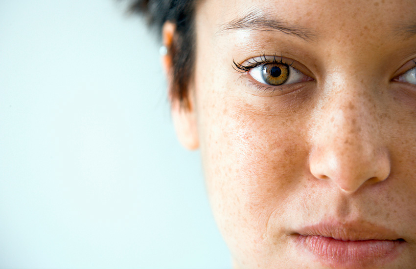 Hamilelikte Cilt Lekeleri Neden Olur, Nasıl Geçer?