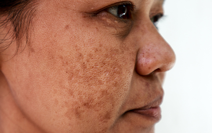 Kloasma-Melazma Nedir, Neden Olur?