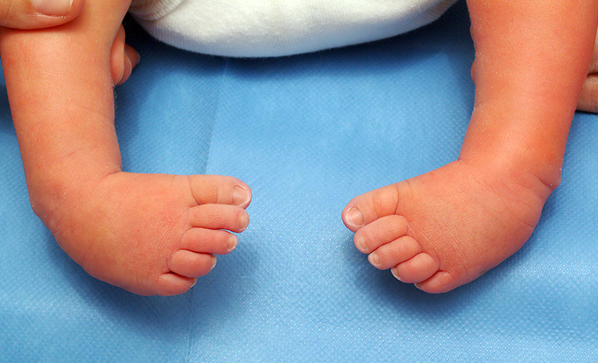 Pes Ekinovarus (Çarpık Ayak) Nedir, Nasıl Tedavi Edilir?