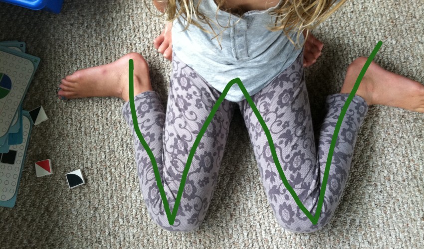 W Oturuşu Zararları Neler, Nasıl Düzeltilir?