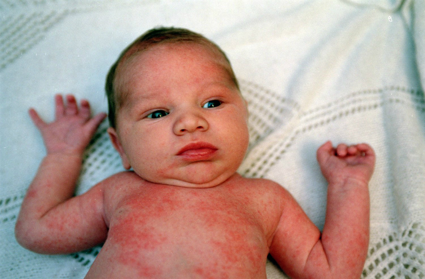 Çocuklarda akut dönemde atopik dermatit tedavisi Çocuklarda akut dönemde atopik dermatit tedavisi