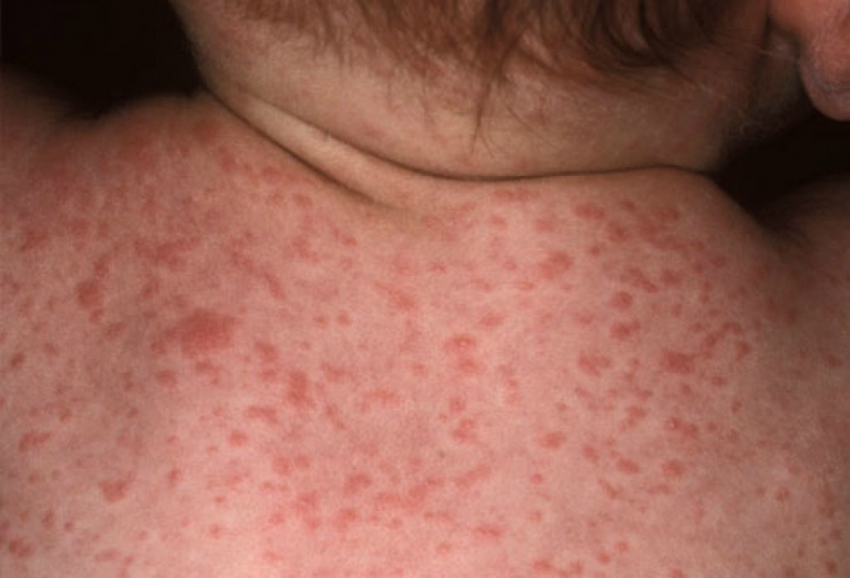 Pediatrik Roseola: Nedenleri ve Belirtileri Pediatrik Roseola: Nedenleri ve Belirtileri
