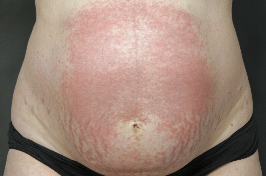 gebelikte kaşıntı