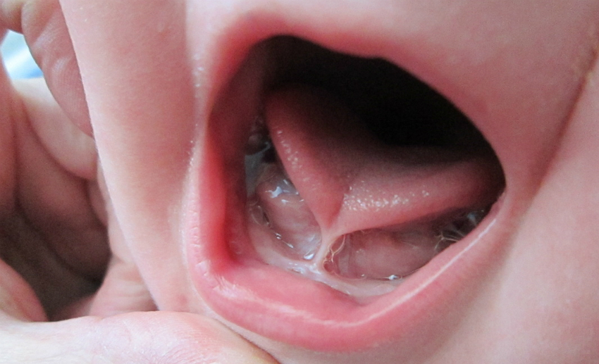 bebeklerde dil bağı