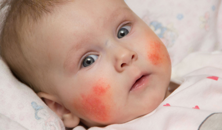 Bebeğin yanakları egzama olmuş bu sebepşe kuru ve kızarmış görünüyor