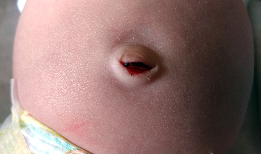 göbek deliği iltihabının belirtileri