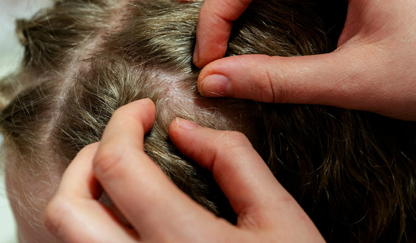 Çocuklarda bit belirtileri nelerdir