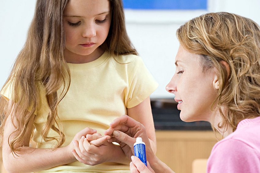 siğil tedavisi nasıl yapılır