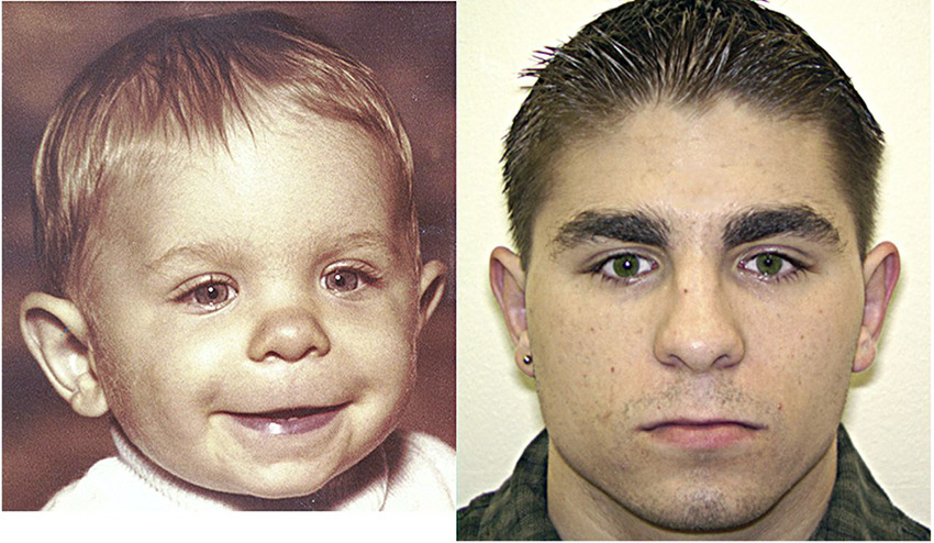 Fetal alkol sendromu tanı kriterleri