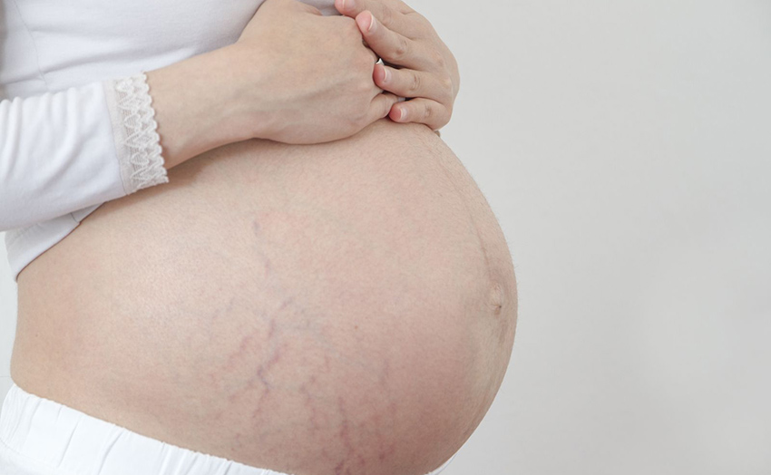 gebelikte çatlak nedenleri