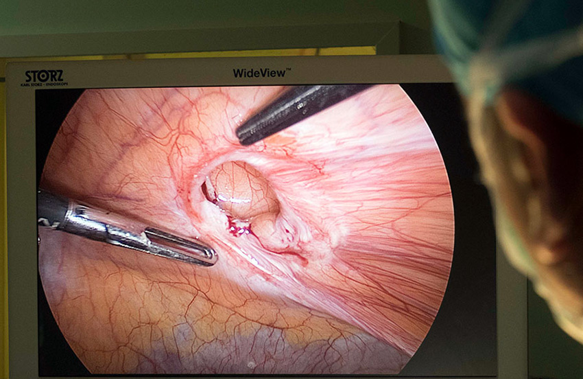 Hamilelikte göbek fıtığı ameliyatı Göbekteki fıtık nasıl geçer