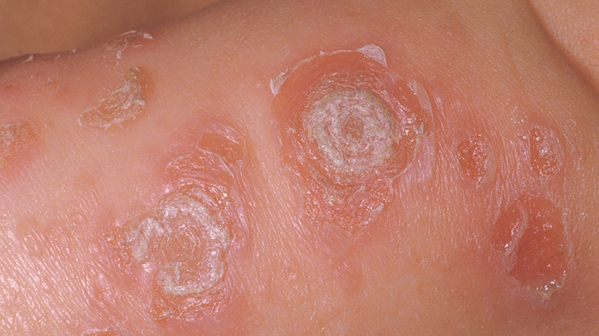 bebeklerde pişik çeşitleri