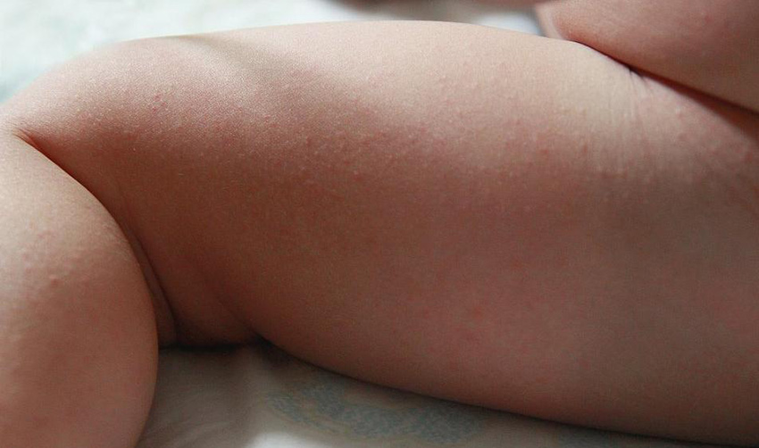 Bebeklerde sivilceli pişik