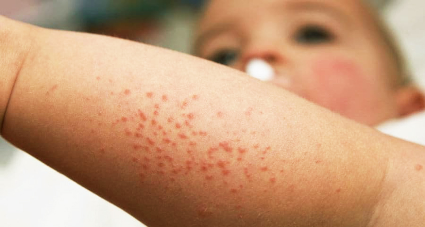 pire ısırığı pire görüntüsü