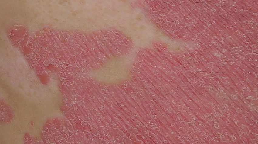 Bebeklerde geçmek bilmeyen pişik