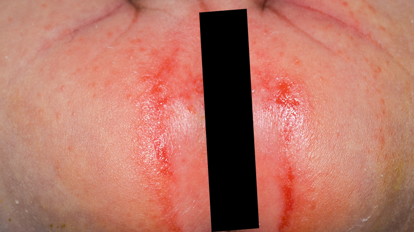 Bebeklerde bez döküntüsü