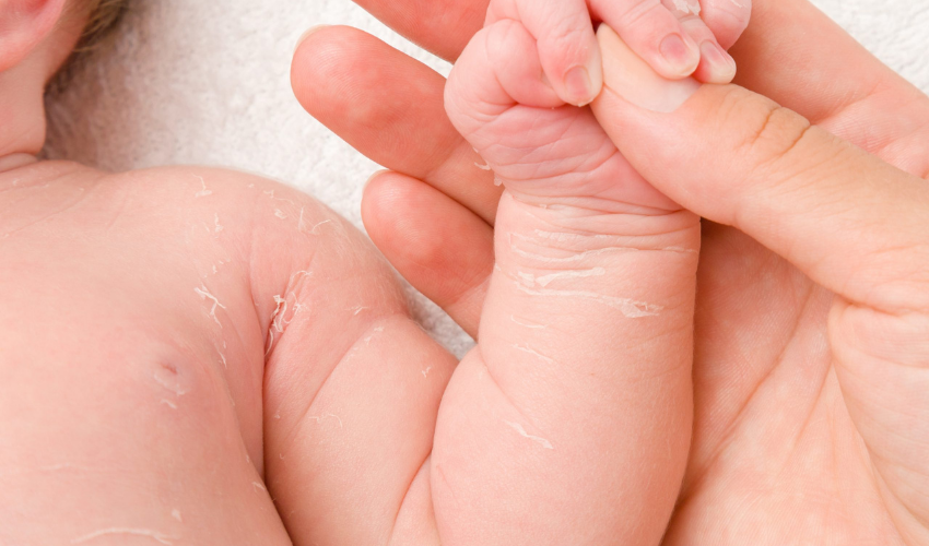 Yenidoğan bebeğin cildi narin olduğu için kurumuş ve soyulmuş